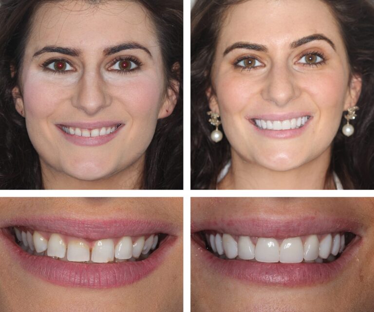 atpt hannah 2 4 anteriors 768x641