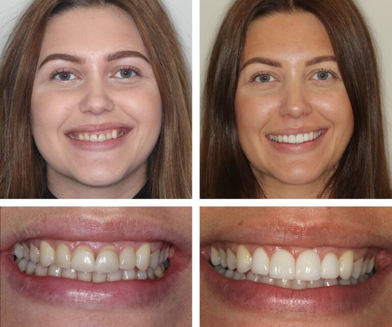 miagummy smile 768x641